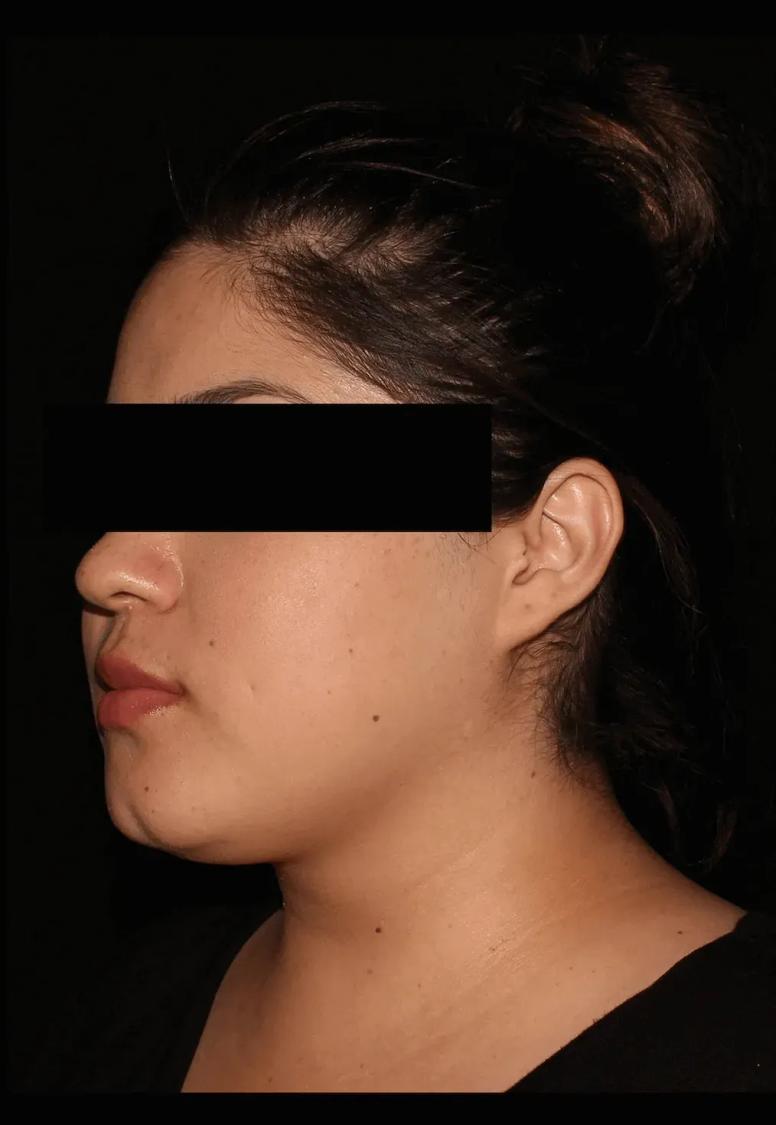 Neck Liposuction w/ Magic Tight before
