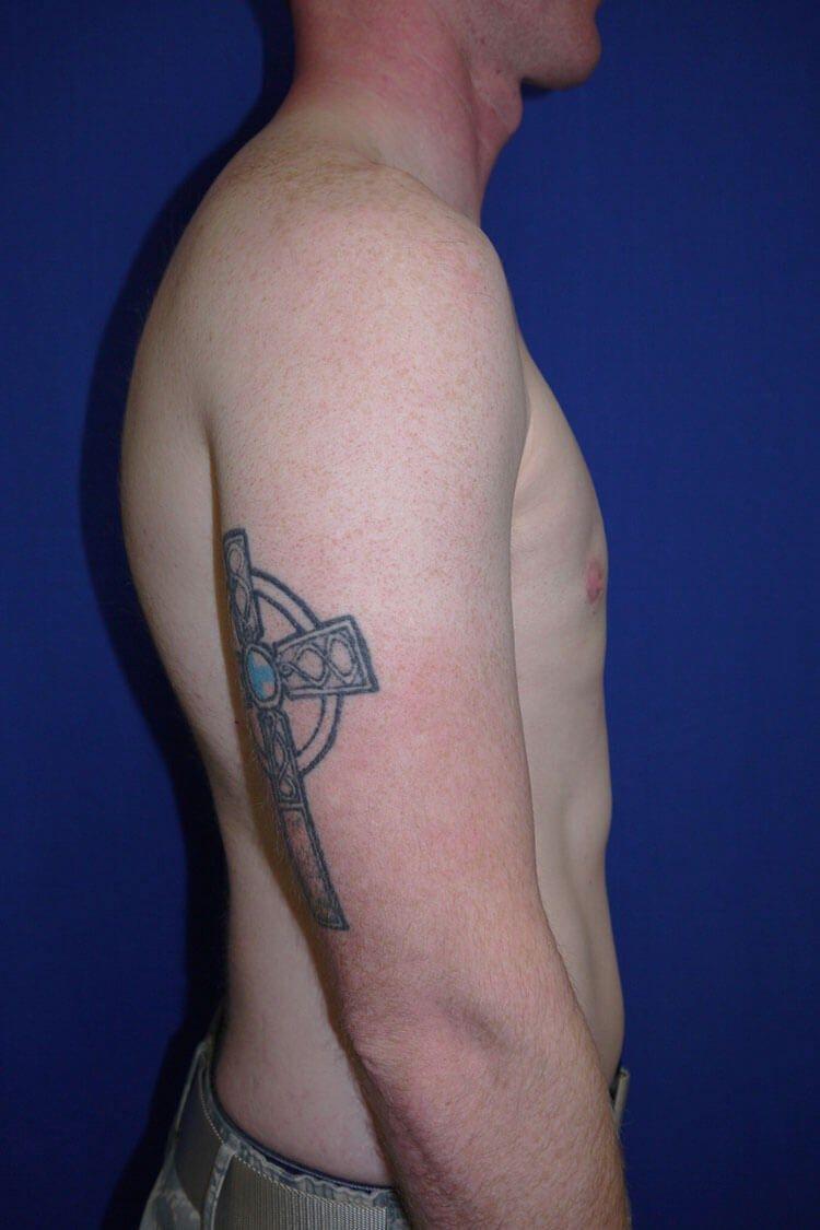 One-Stitch Gynecomastia, view 2, after