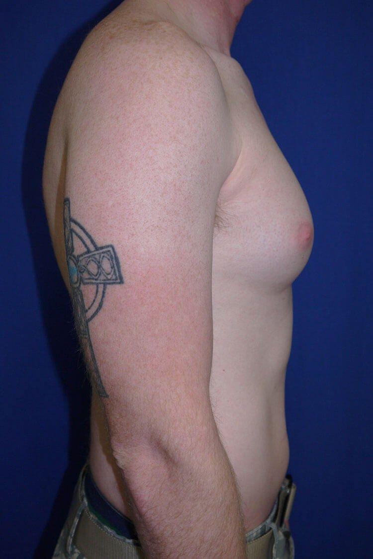 One-Stitch Gynecomastia, view 2, before
