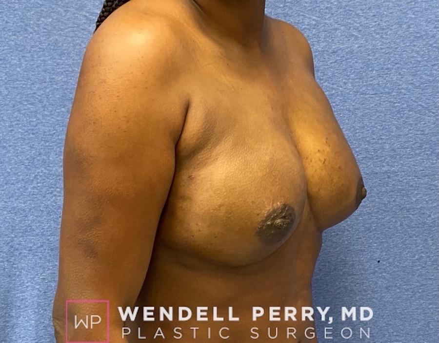 Fat Transfer To the Breast, view 2, after