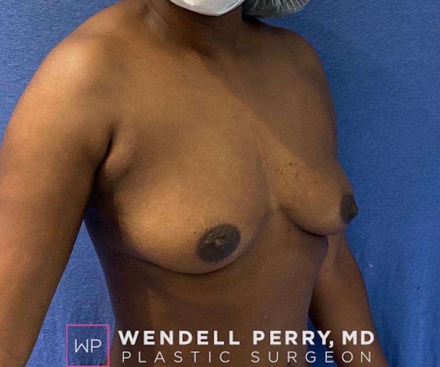 Fat Transfer To the Breast, view 2, before