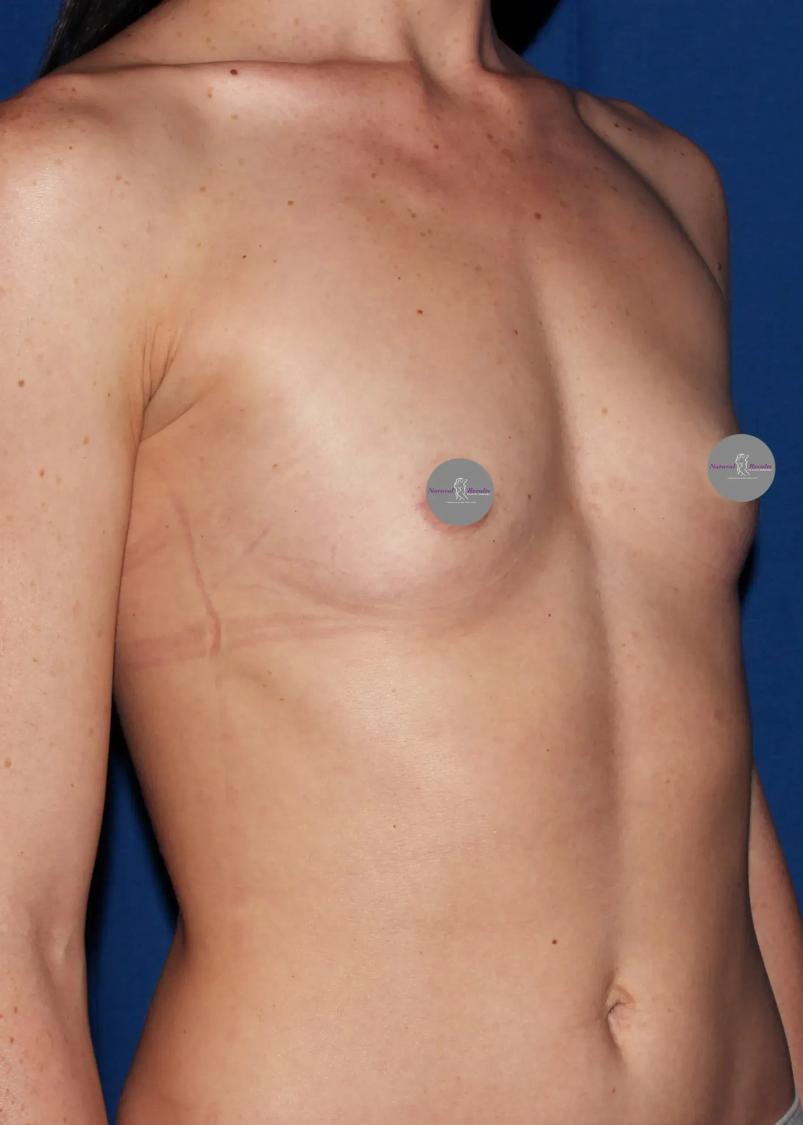 Breast Augmentation with Implants, view 2, before