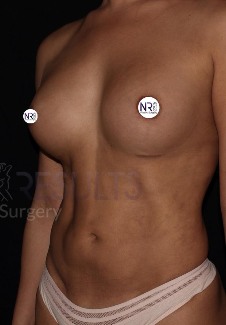 Vaser Lipo 360 (5L Max) after