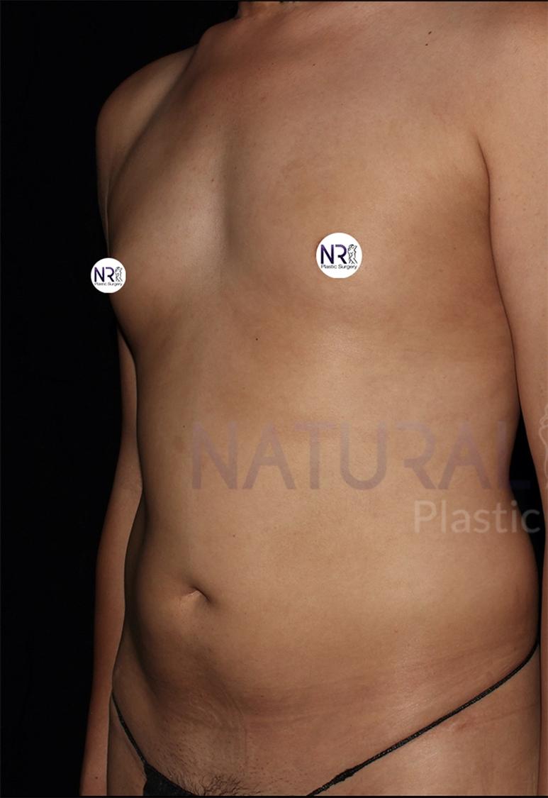 Vaser Lipo 360 (5L Max) before