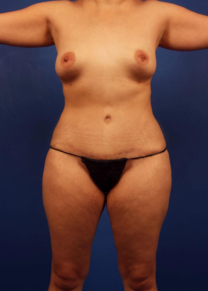 Tummy Tuck after