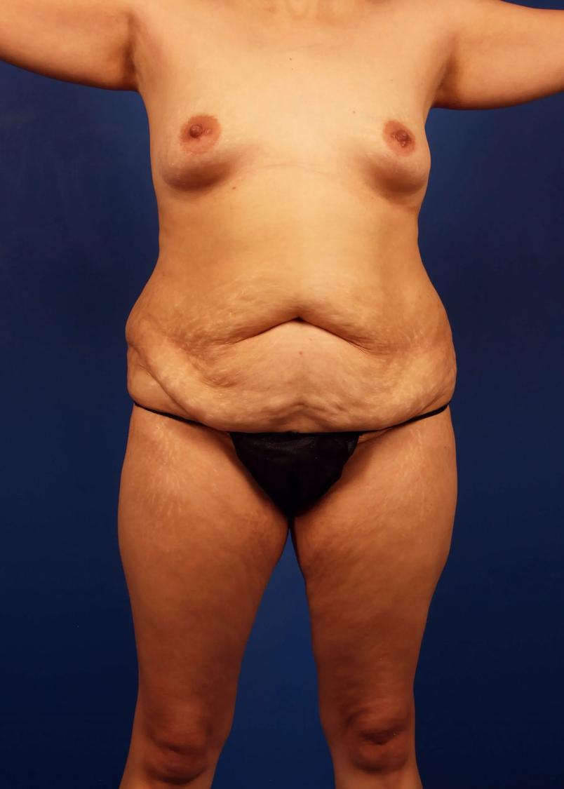 Tummy Tuck before