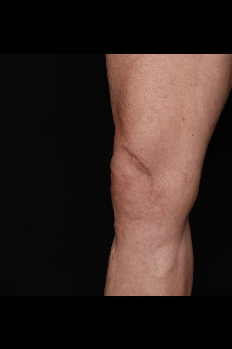 Thigh Lift (Medial), view 2, after