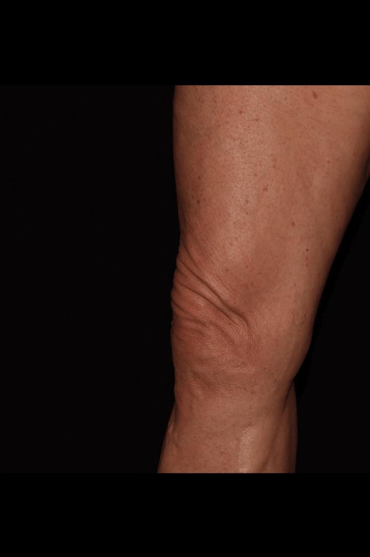 Thigh Lift (Medial), view 2, before