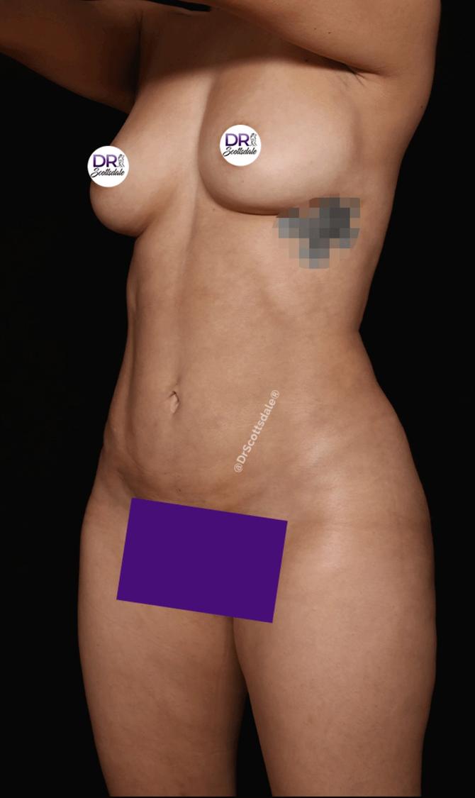 Vaser Lipo 360 (5L Max) after