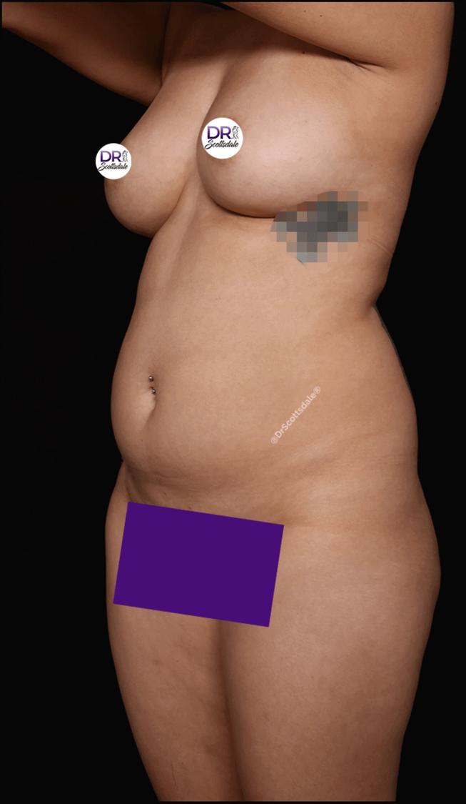 Vaser Lipo 360 (5L Max) before