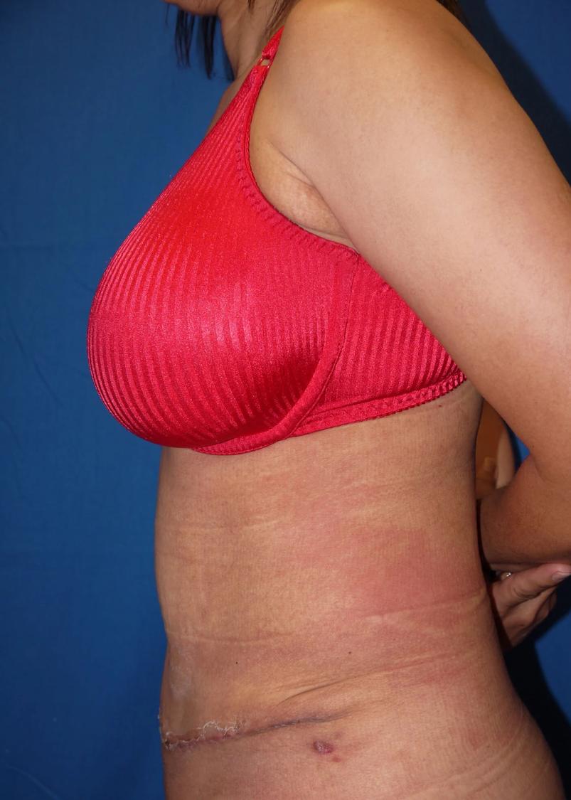 Tummy Tuck, view 3, after