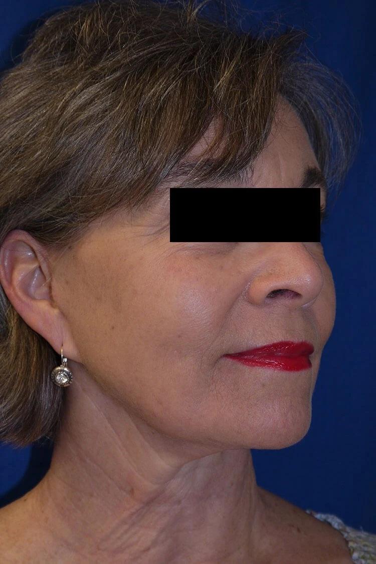 Facelift (neck lift included) after