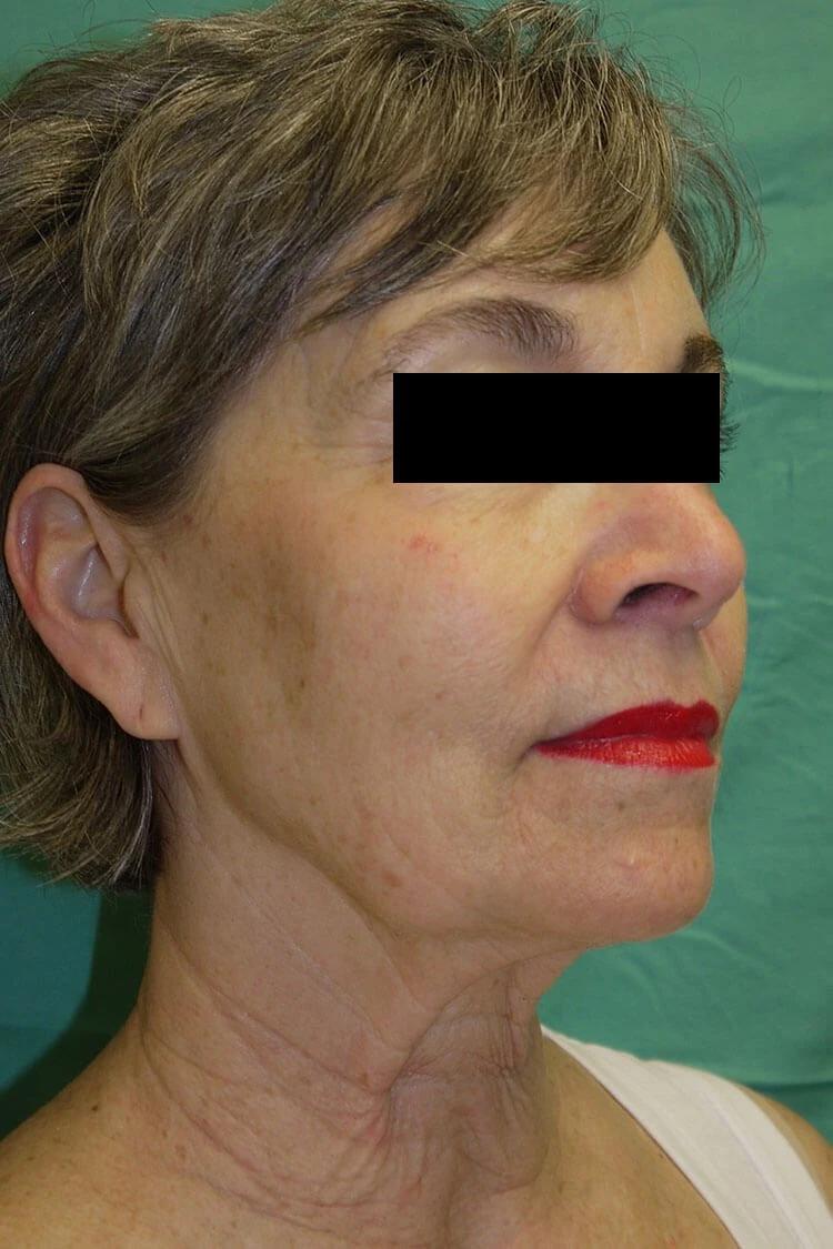 Facelift (neck lift included) before