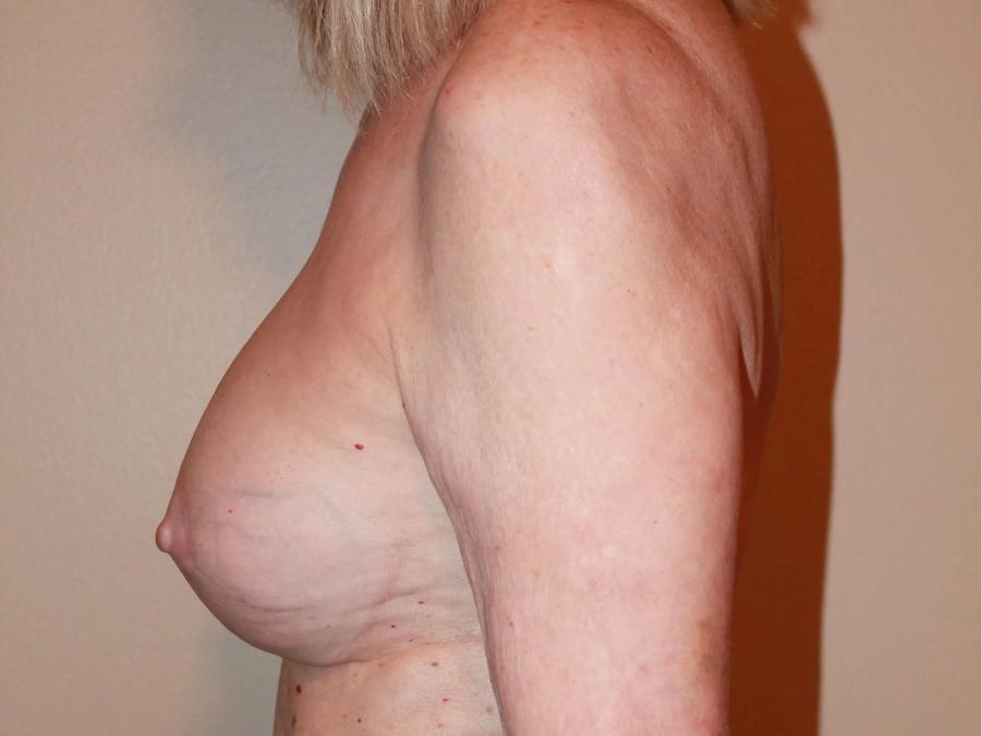 Breast Augmentation with Implants after