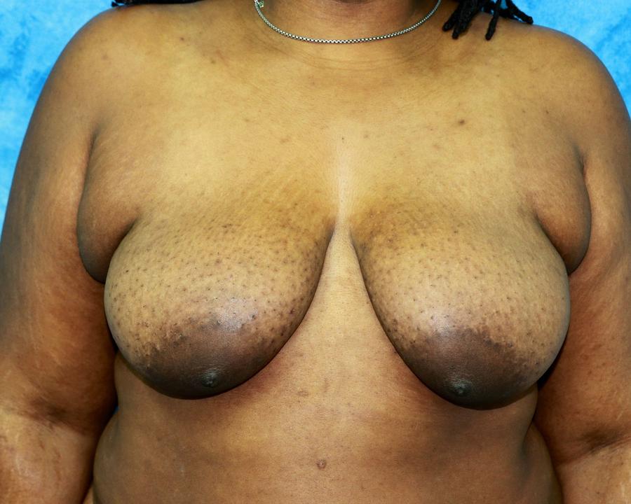 Fat Transfer To the Breast before