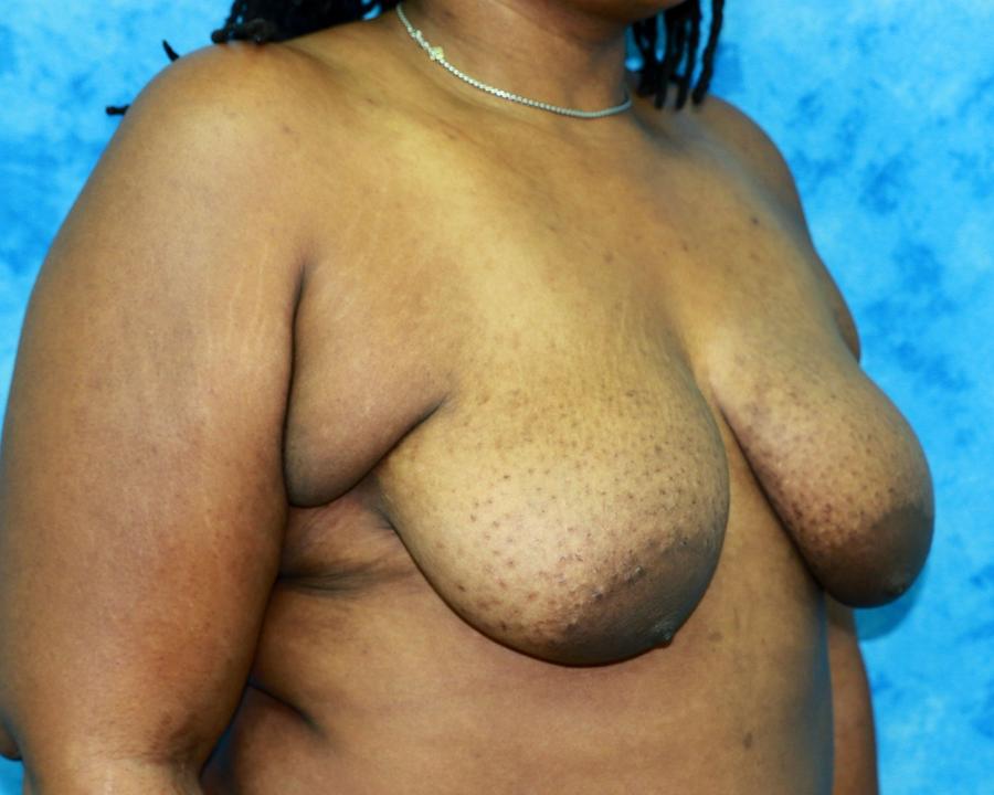 Fat Transfer To the Breast, Oblique Left view, before