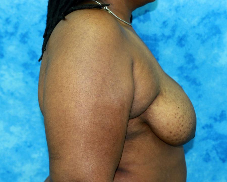 Fat Transfer To the Breast, Left Profile view, before