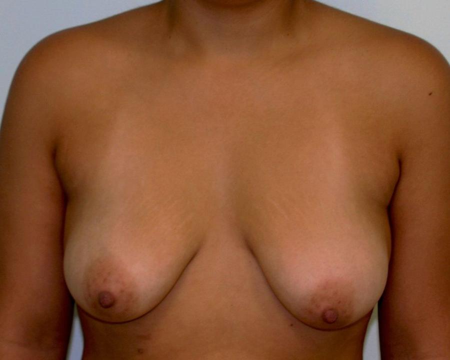 Breast Augmentation with Implants before