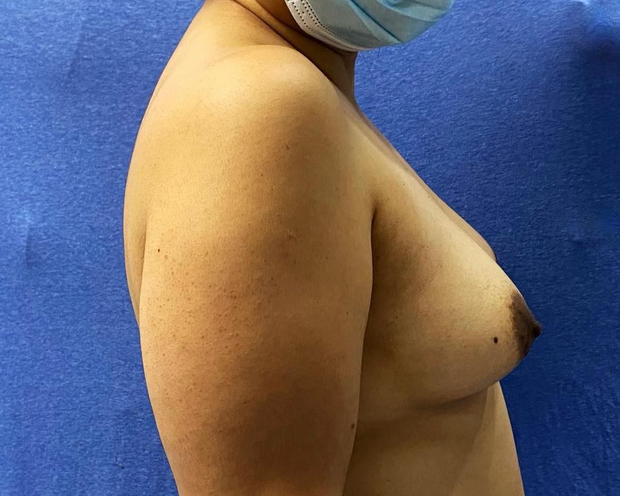 Fat Transfer To the Breast, Right Profile view, before