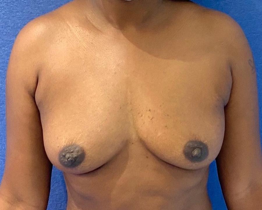 Fat Transfer To the Breast before
