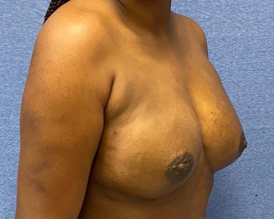 Fat Transfer To the Breast, Oblique Right view, after