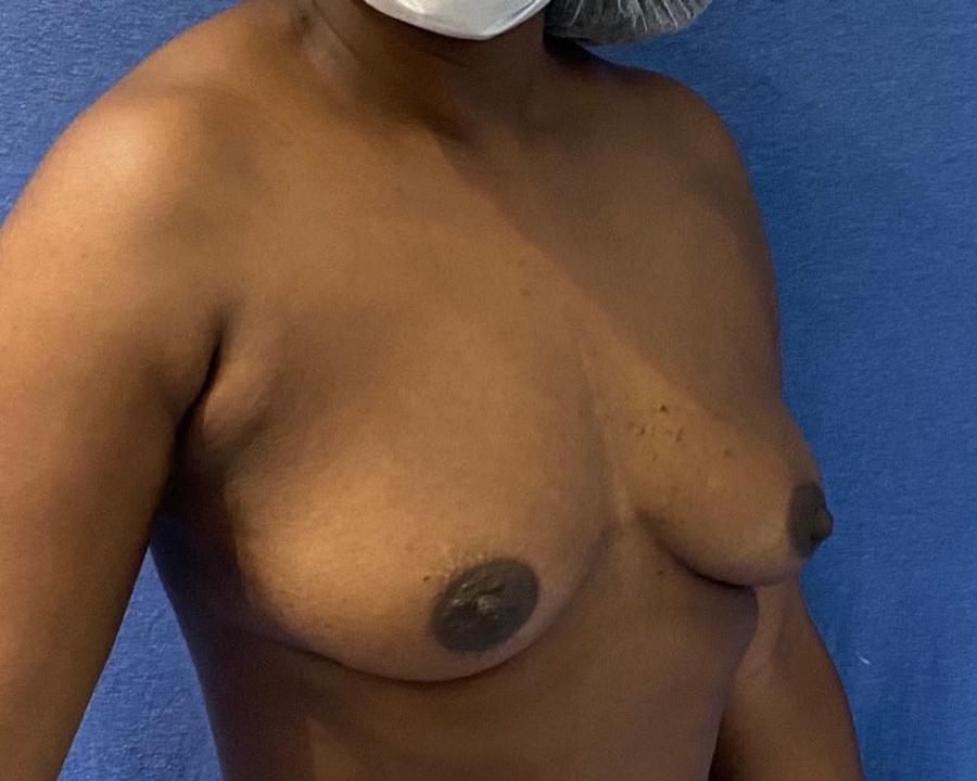 Fat Transfer To the Breast, Oblique Right view, before