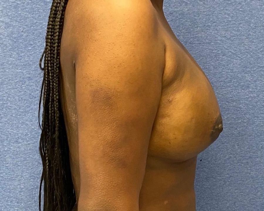 Fat Transfer To the Breast, Right Profile view, after