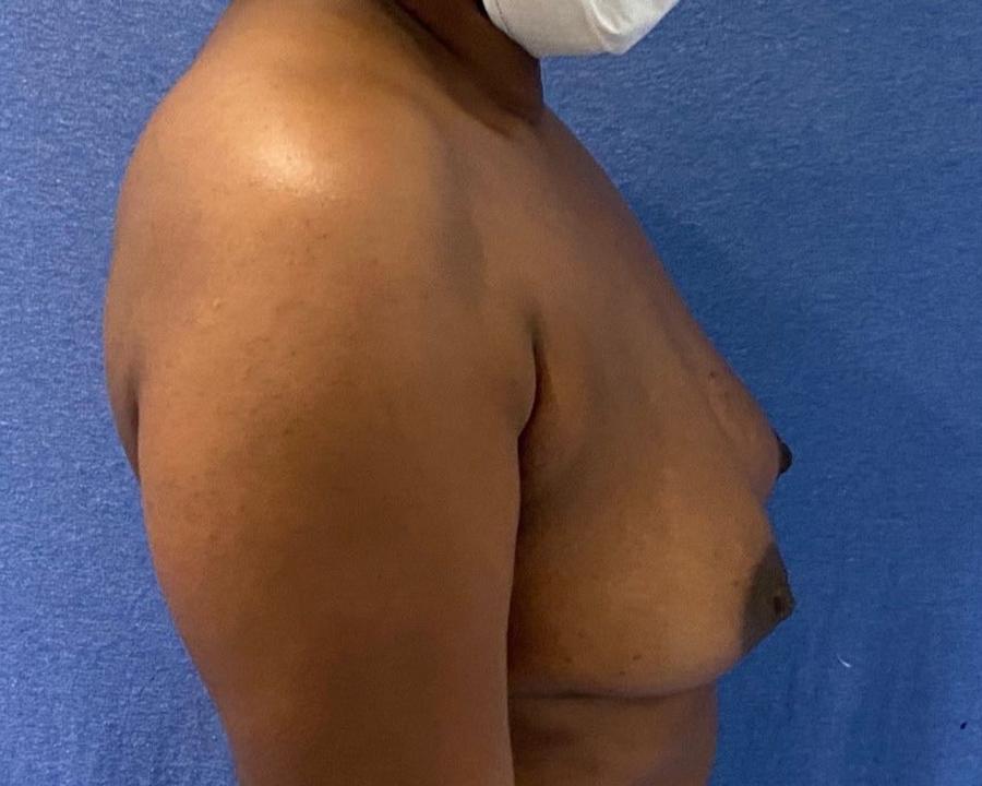 Fat Transfer To the Breast, Right Profile view, before