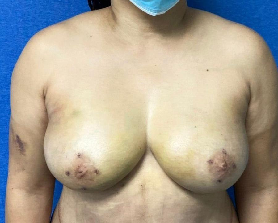 Fat Transfer To the Breast after