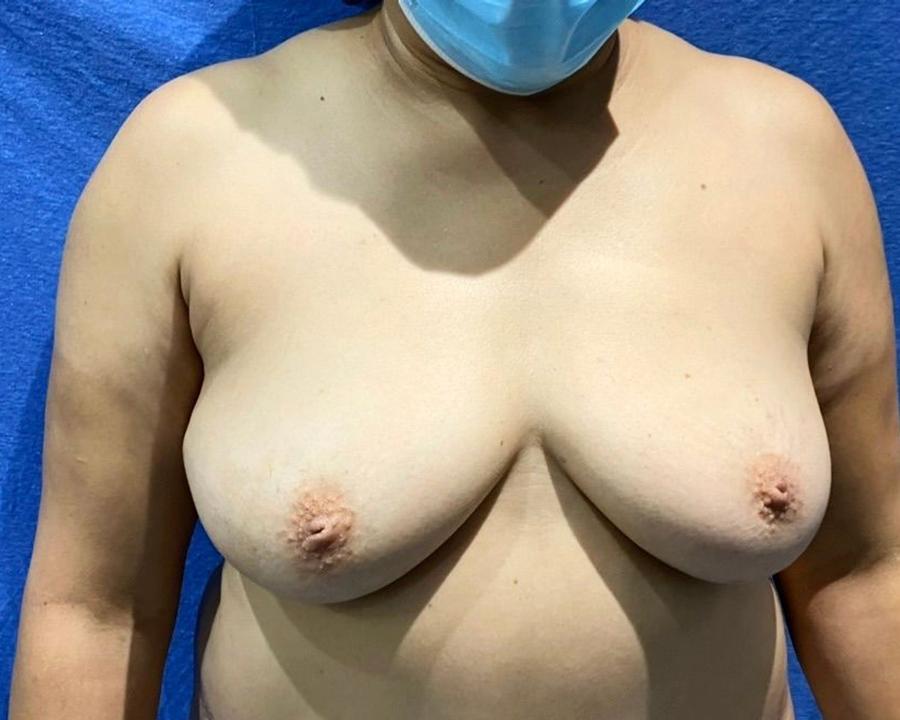 Fat Transfer To the Breast before