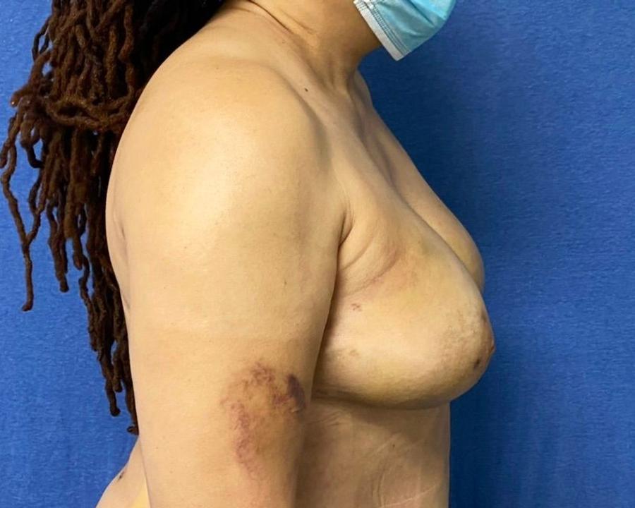 Fat Transfer To the Breast, Right Profile view, after