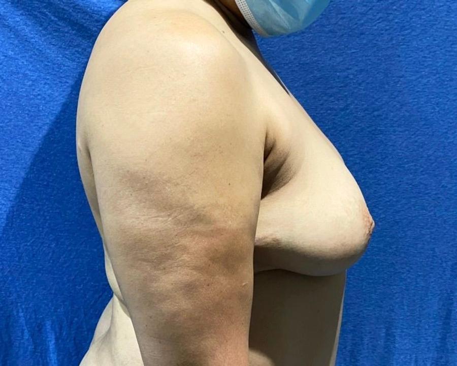 Fat Transfer To the Breast, Right Profile view, before