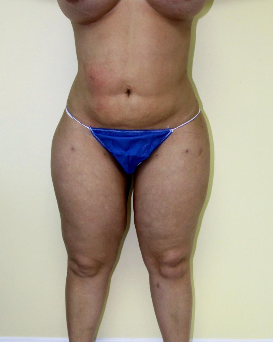 Liposuction after
