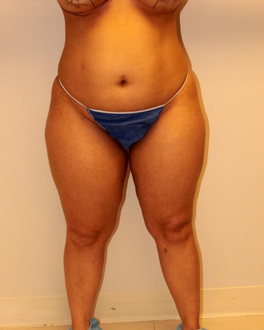 Liposuction before