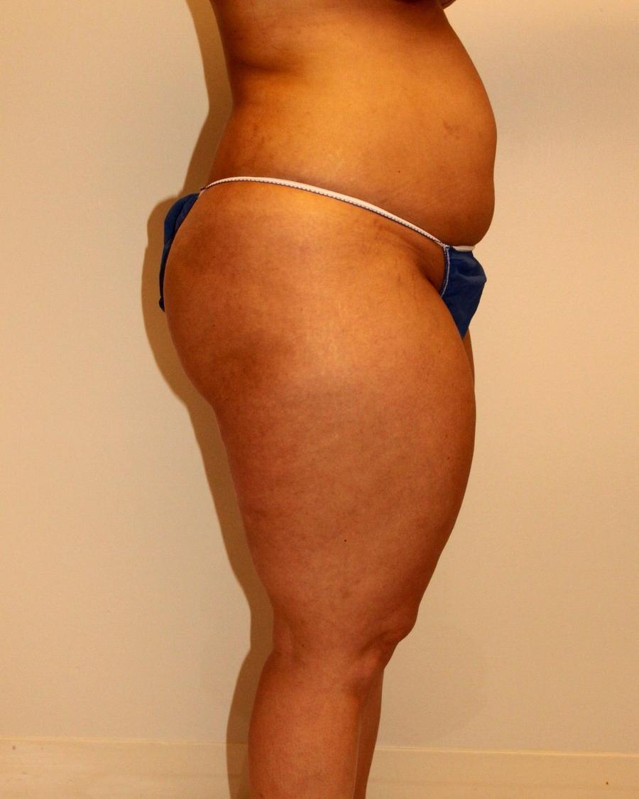 Liposuction, Right Profile view, before