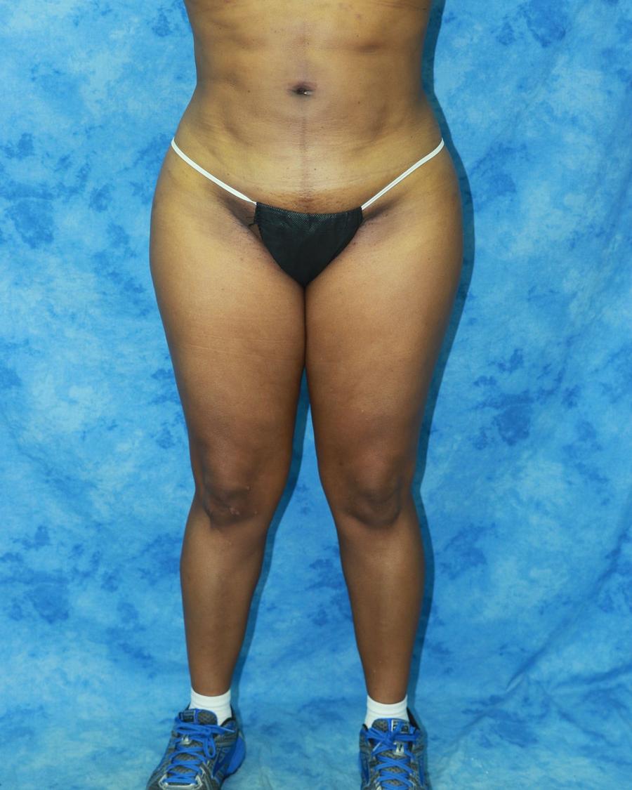 Liposuction after