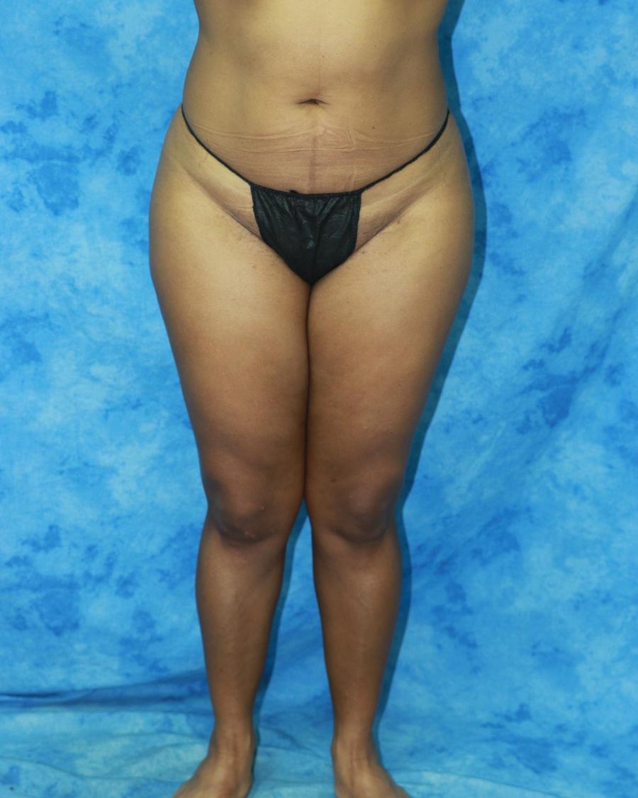 Liposuction before