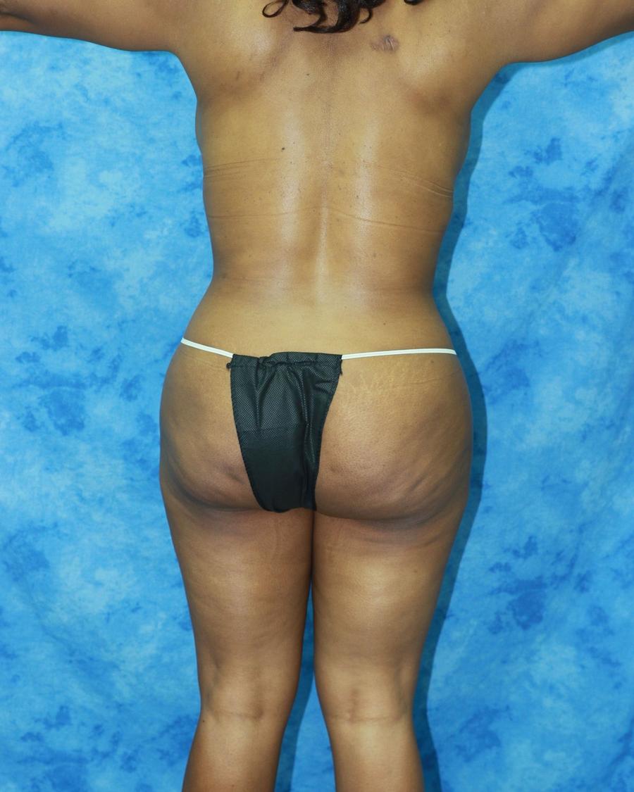 Liposuction, Back view, after