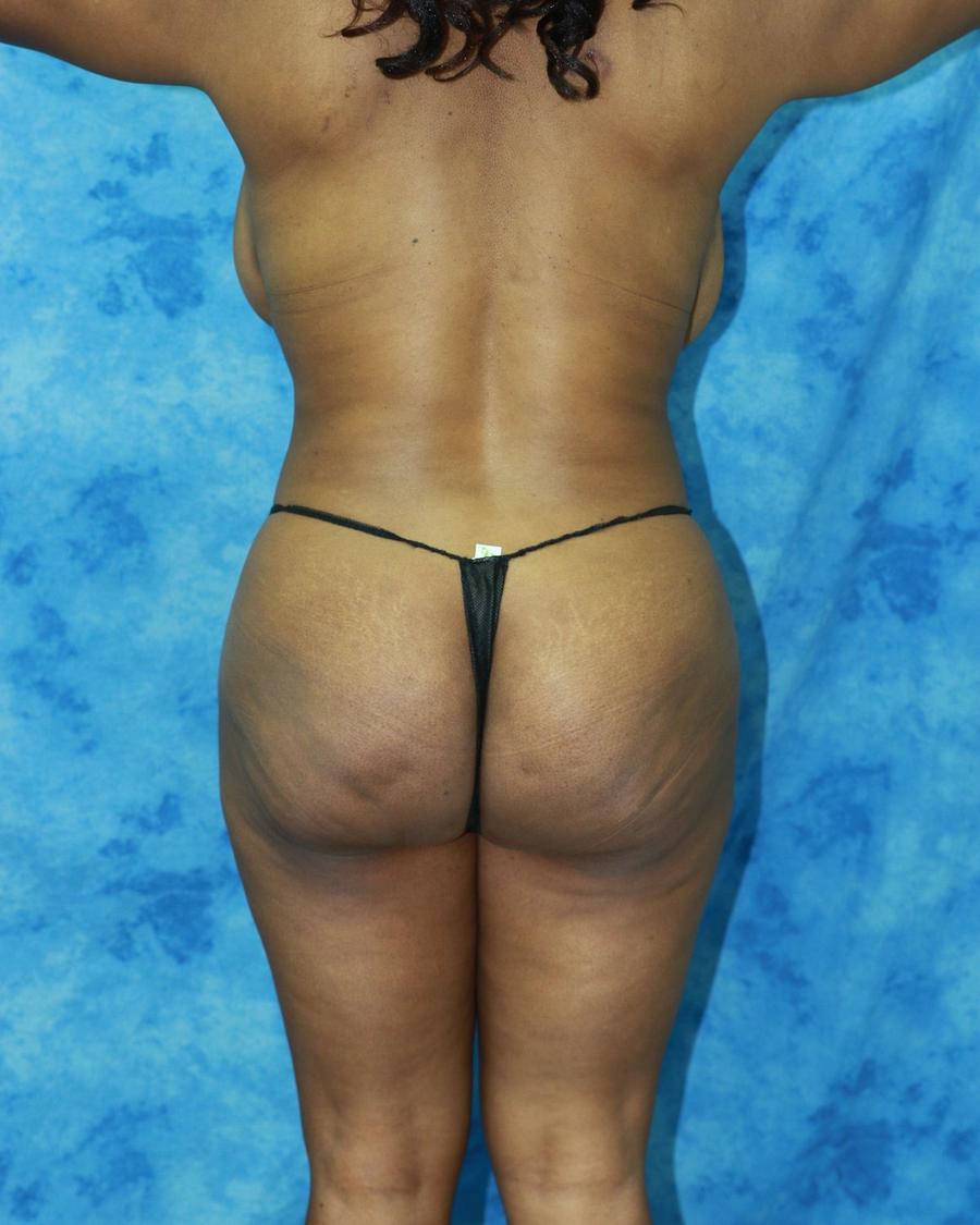 Liposuction, Back view, before