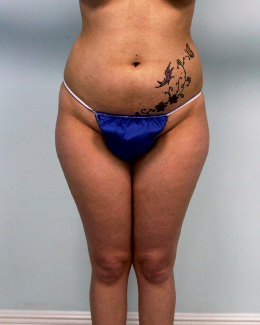 Liposuction before