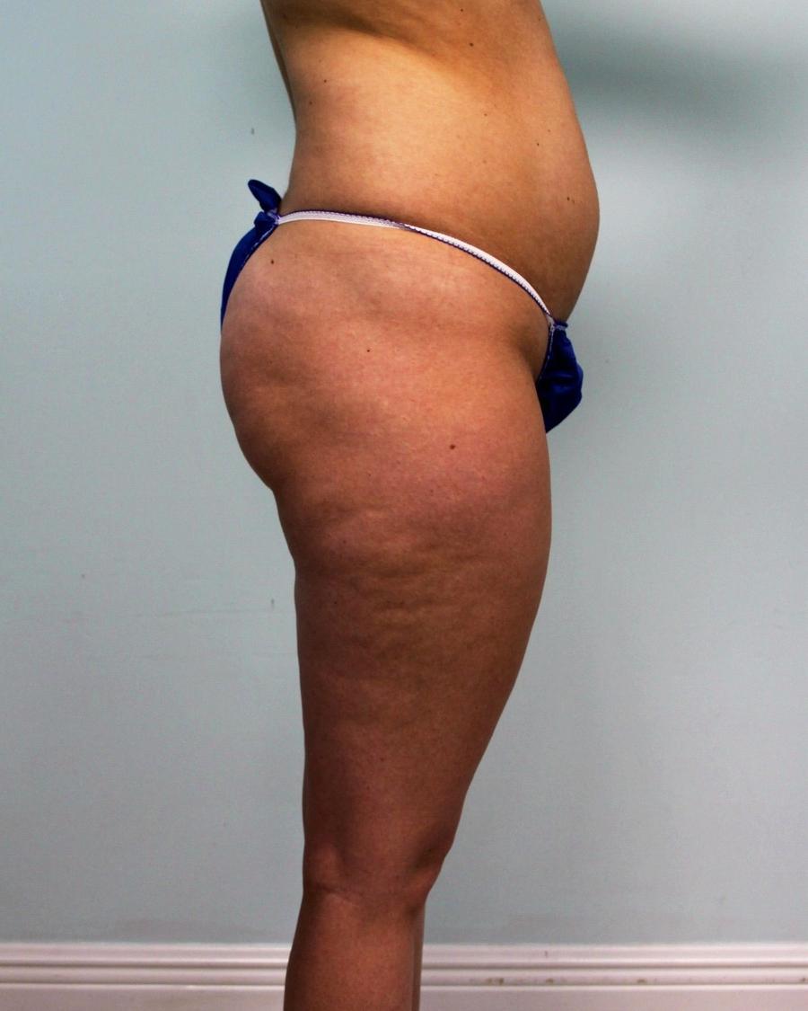 Liposuction, Right Profile view, before