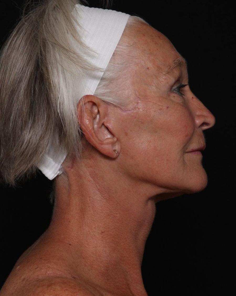 Facelift (neck lift included), view 4, after