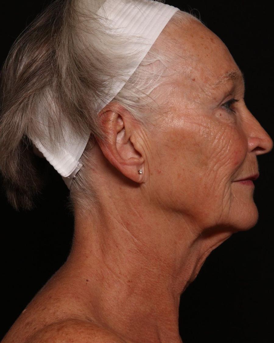 Facelift (neck lift included), view 4, before