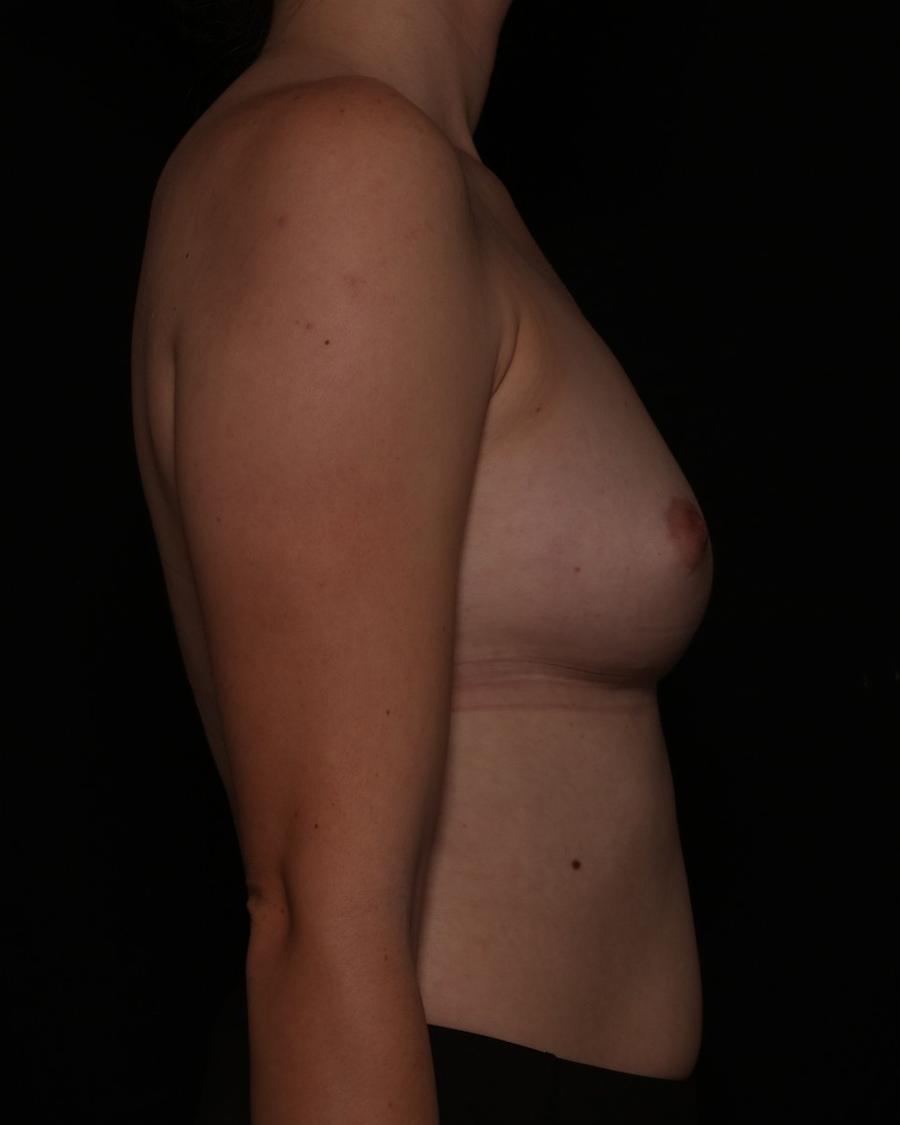 Breast Augmentation with Implants, view 4, before