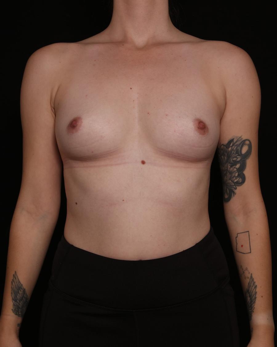 Breast Augmentation with Implants before