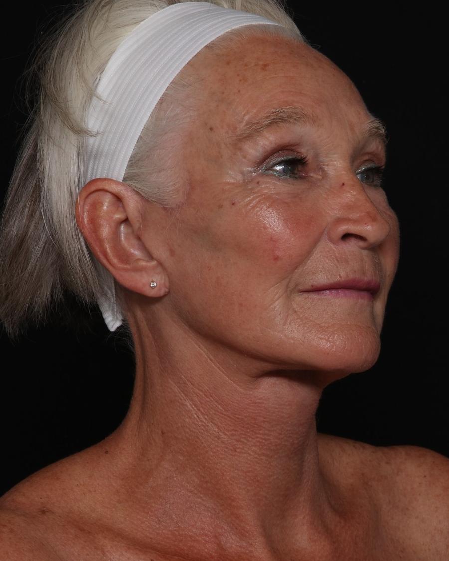 Facelift (neck lift included) after