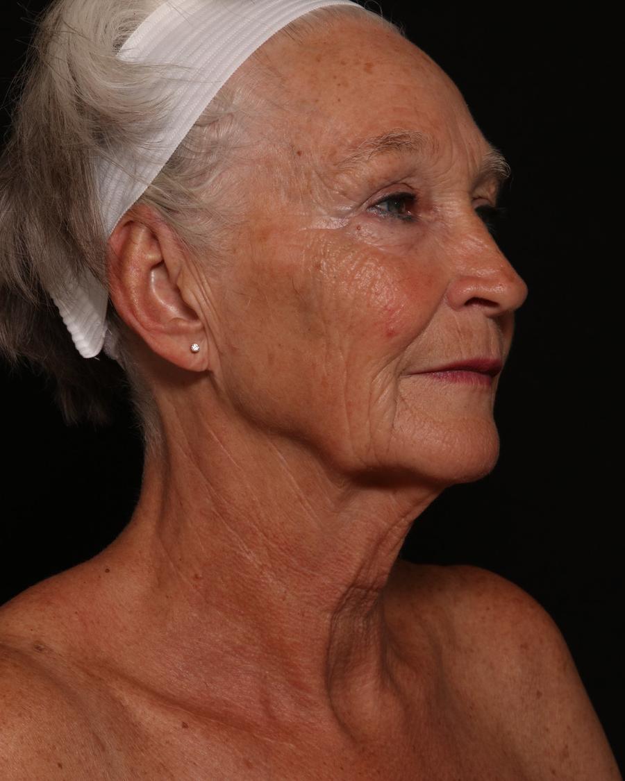Facelift (neck lift included) before