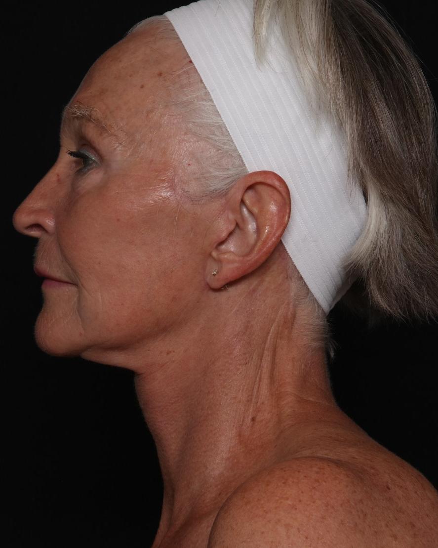 Facelift (neck lift included), view 5, after