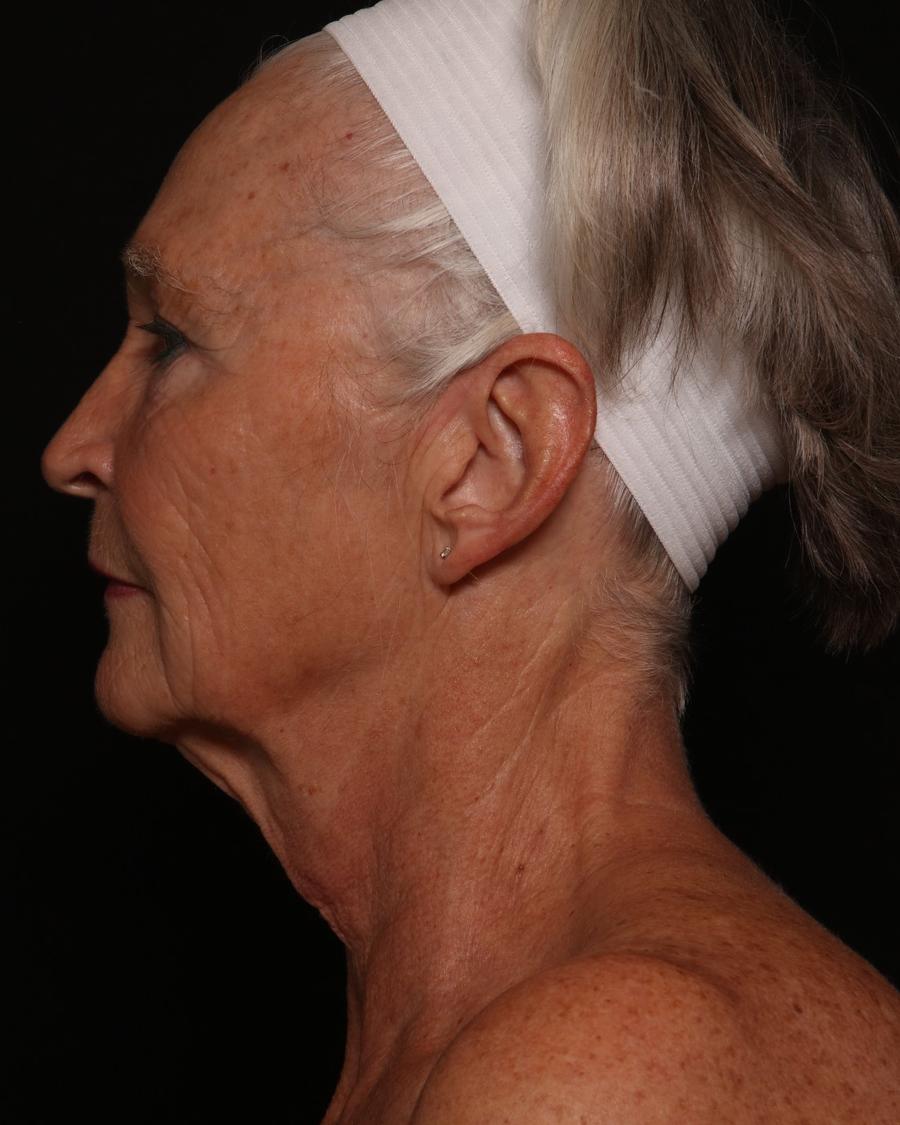 Facelift (neck lift included), view 5, before