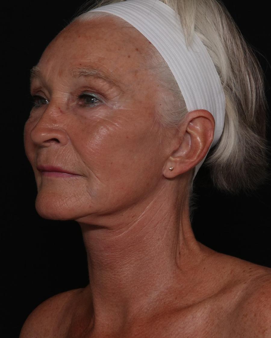 Facelift (neck lift included), view 4, after